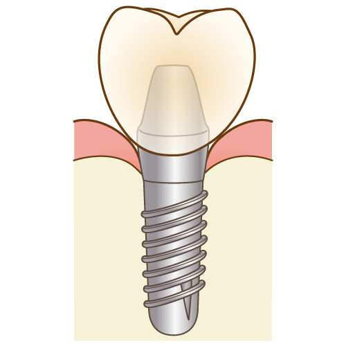 インプラント